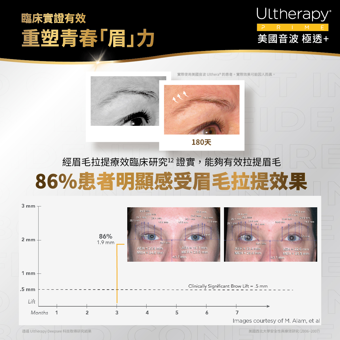 UItherapy PRIME 美國音波二代-淨透+
